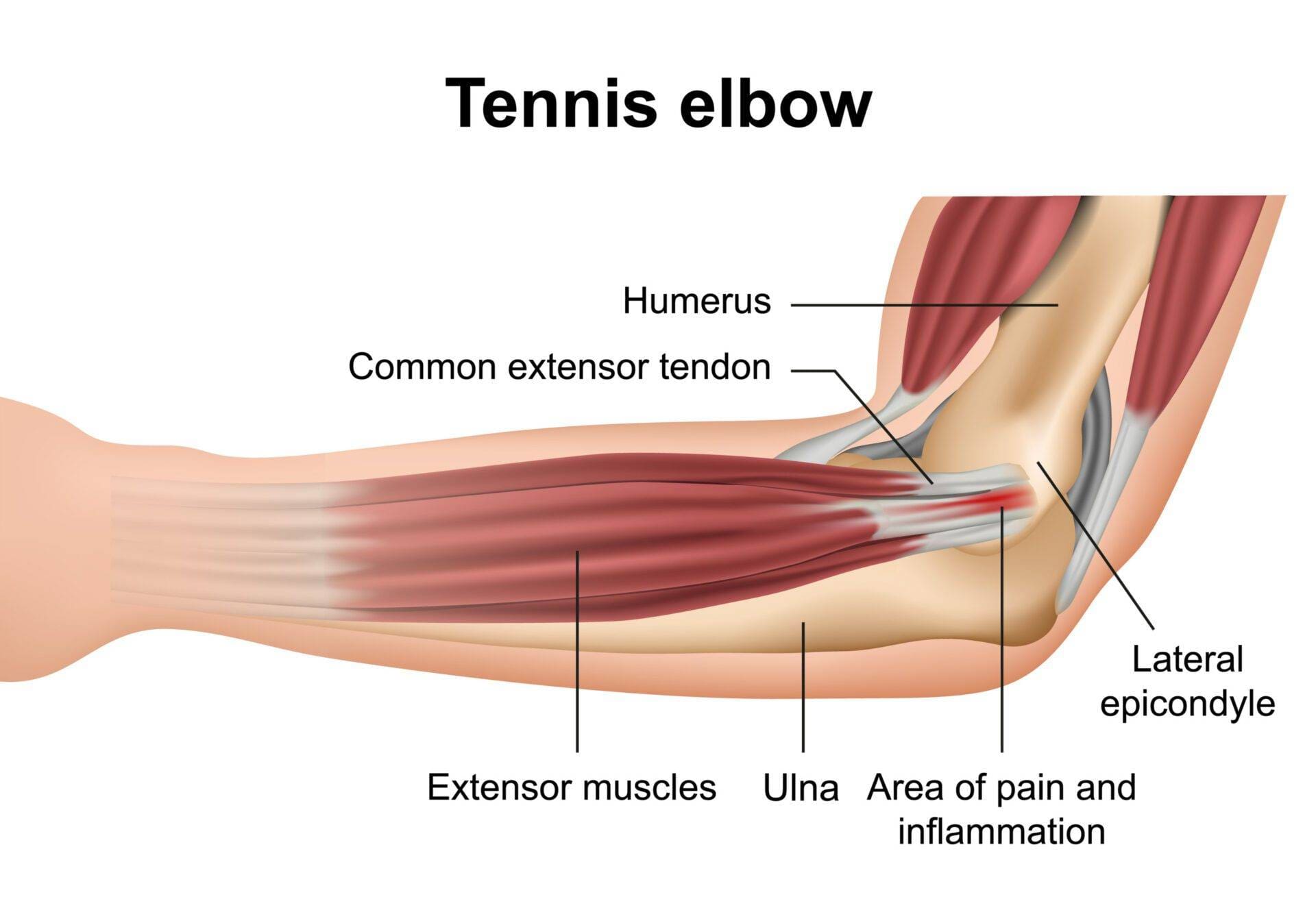 Tennis elbow injury medical vector illustration on white background